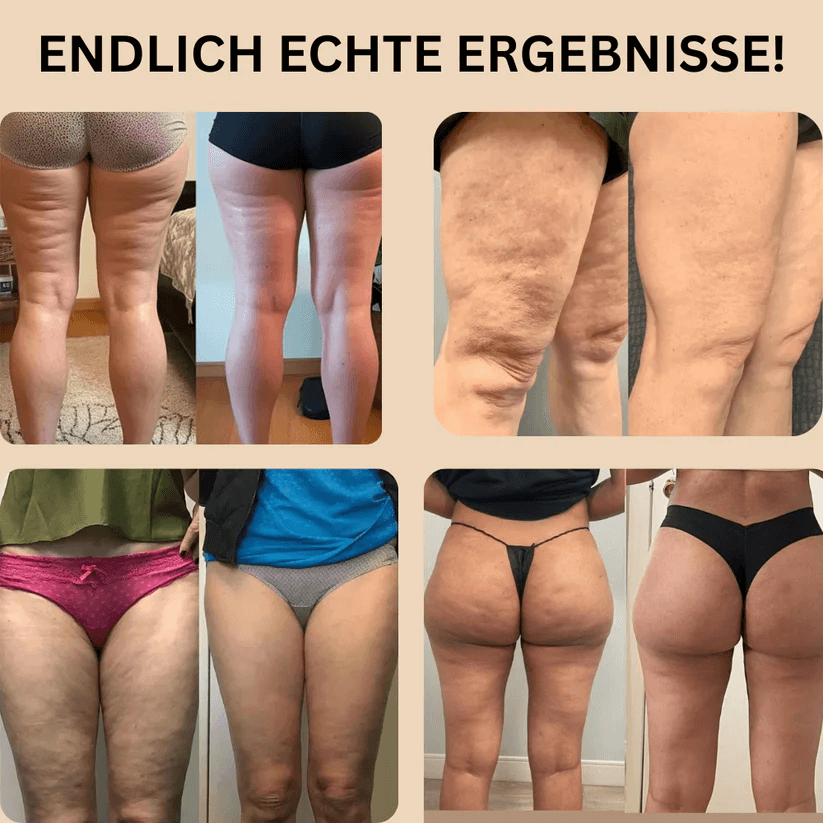 3D Anti-Cellulite-Leggings